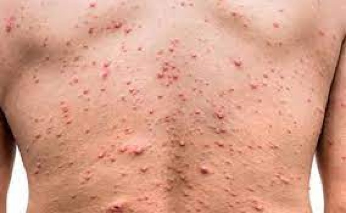 جدري القرود ـ انطلاق البحث عن لقاح وألمانيا توصي بعزل المصابين