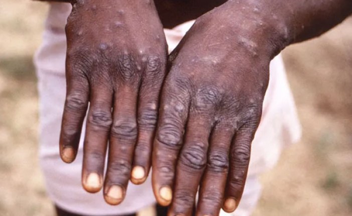 سيراليون تعلن حالة الطوارئ الصحية بسبب جدري القردة