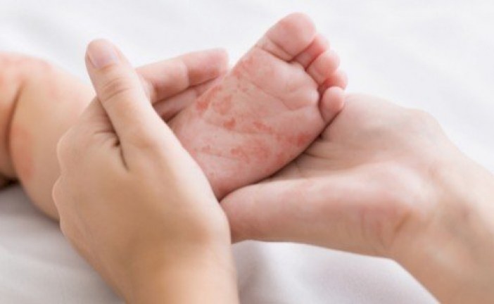 بايتاس: الحكومة تقوم بمجهودات كبيرة لمواجهة مرض الحصبة