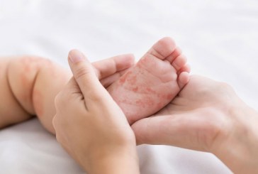 بعد انتشاره وإعلانه “وباء”.. هذه خطة الحكومة لمواجهة “بوحمرون”
