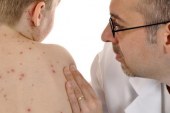 تسجيل انخفاض متواصل في حالات الإصابة بفيروس الحصبة للأسبوع الخامس على التوالي