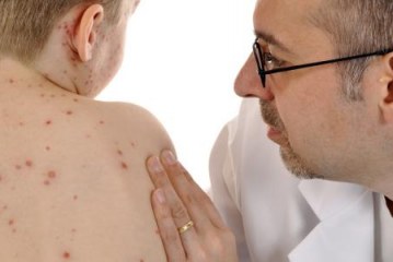 تسجيل انخفاض متواصل في حالات الإصابة بفيروس الحصبة للأسبوع الخامس على التوالي