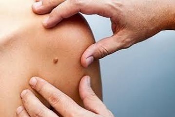 طنجة تحتضن النسخة الثالثة من يوم مفتوح مخصص للكشف المبكر عن سرطانات الجلد